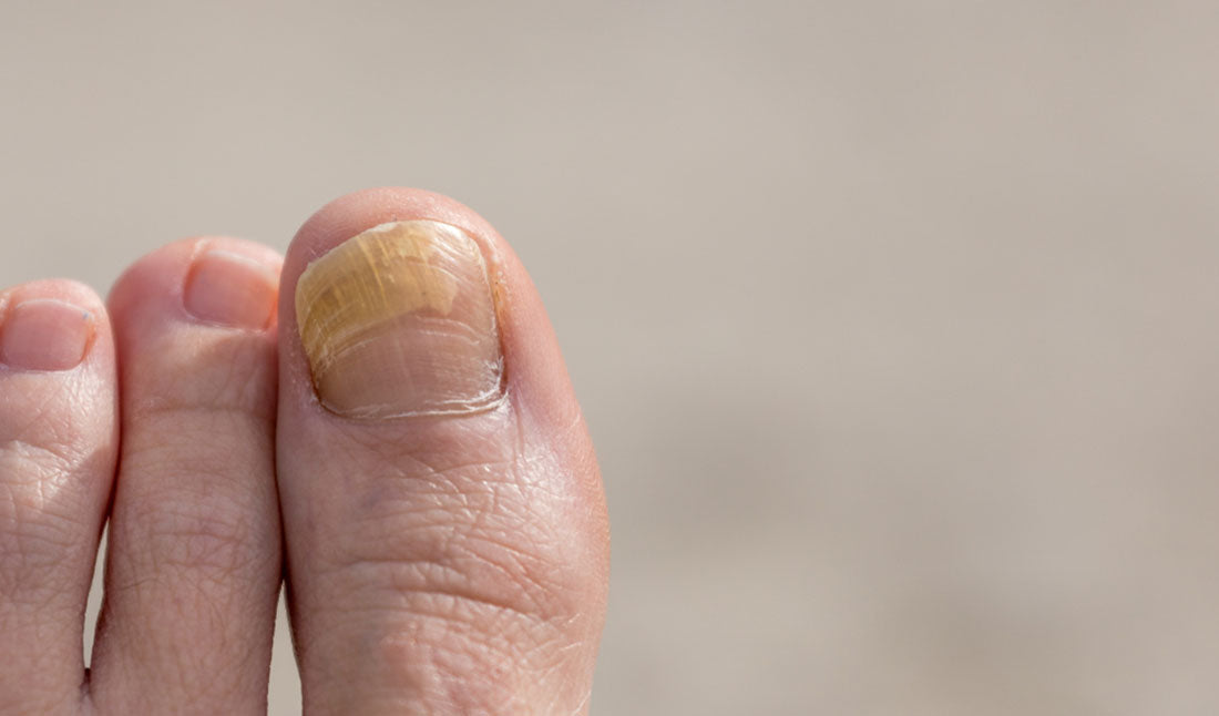 Thick and Gnarly Toenails: Causes, Symptoms and Treatment
