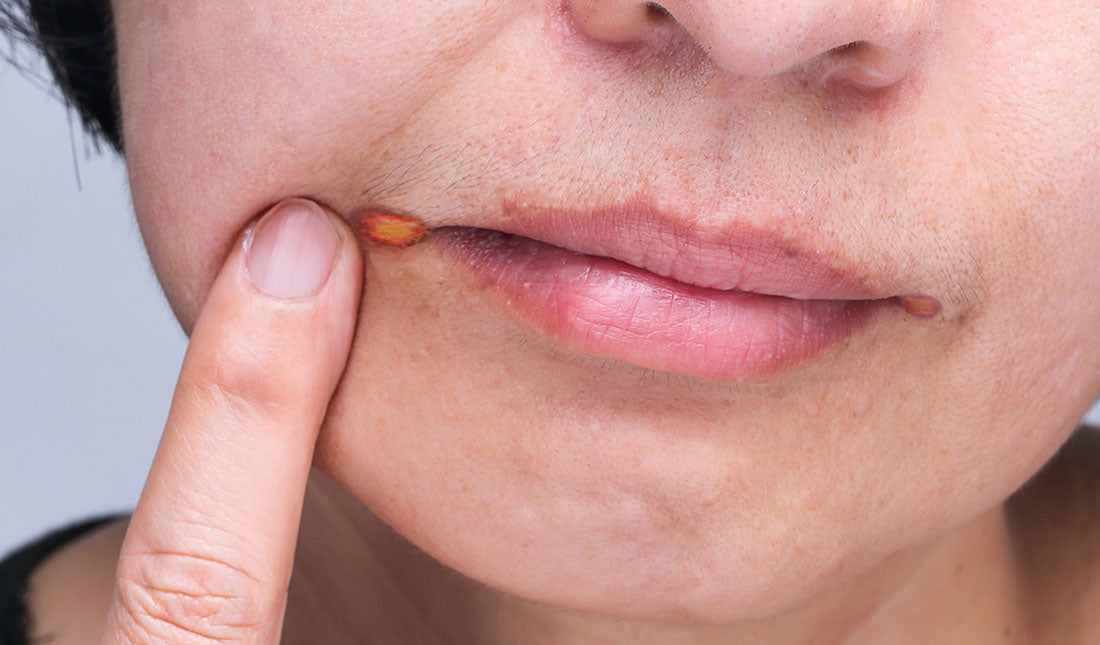 angular cheilitis lip closeup