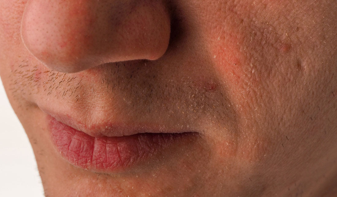 closeup mans face with dry skin