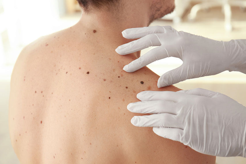 dermatologist checking moles on patients back