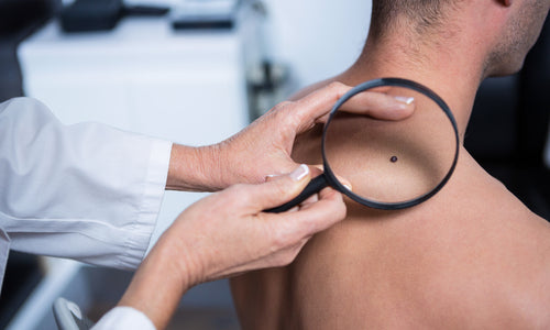 dermatologist examining mole on mans back