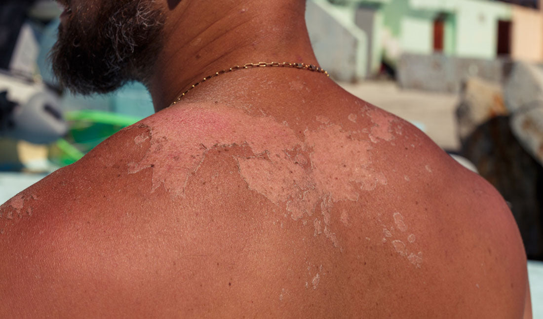 detail shot of skin peeling from sunburn