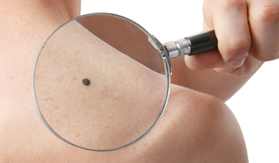 magnifying mole on back
