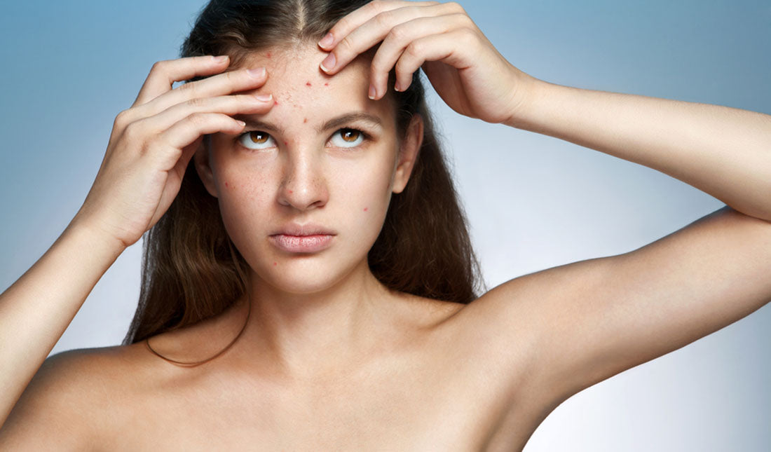 woman with acne between brows